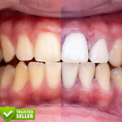 Purple V34™ | Witte tanden in slechts 5 minuten!