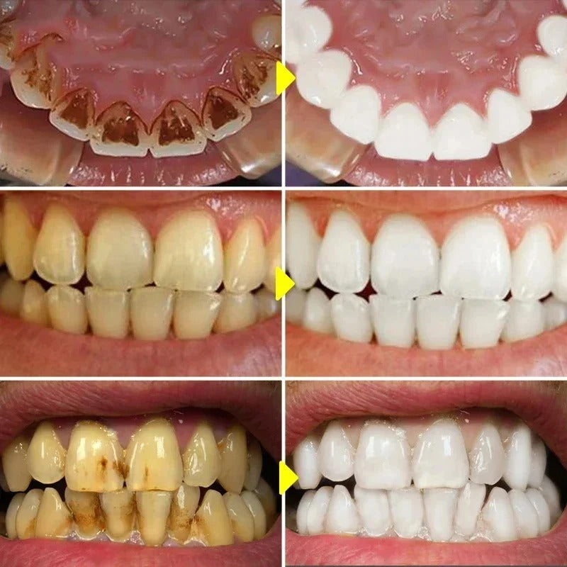 Purple V34™ | Witte tanden in slechts 5 minuten!